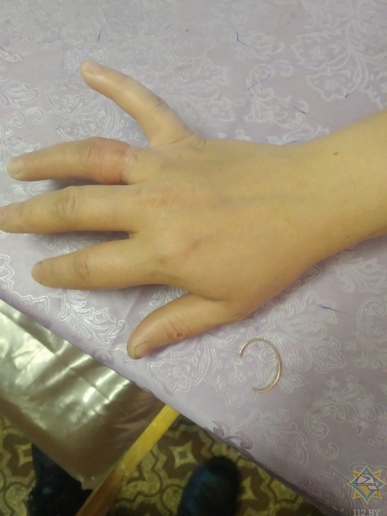 В Гомеле сотрудники МЧС спасли девушку от кольца на пальце