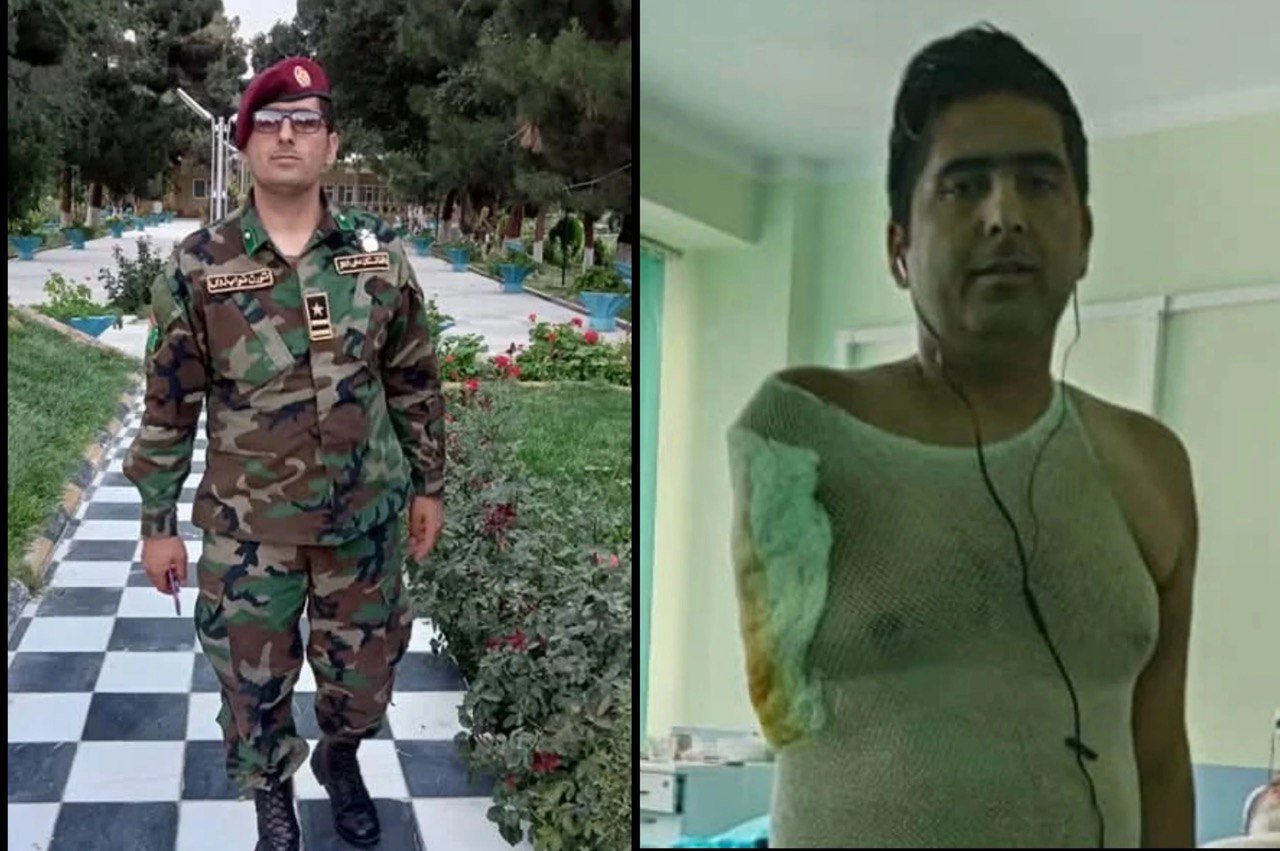 Бывшему сотруднику Минобороны Афганистана ампутировали руку после избиений в Беларуси — СМИ