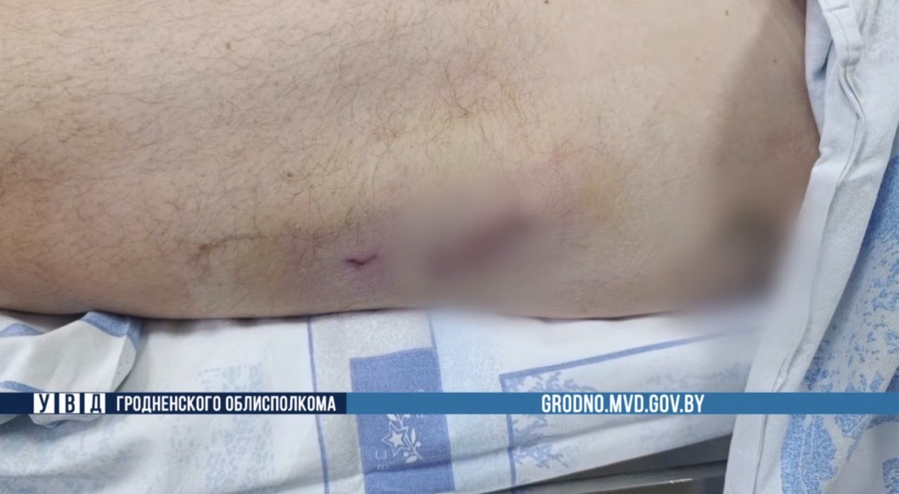 В Гродненской области госпитализировали мужчину с огнестрельными ранениями, полученными в Польше — МВД